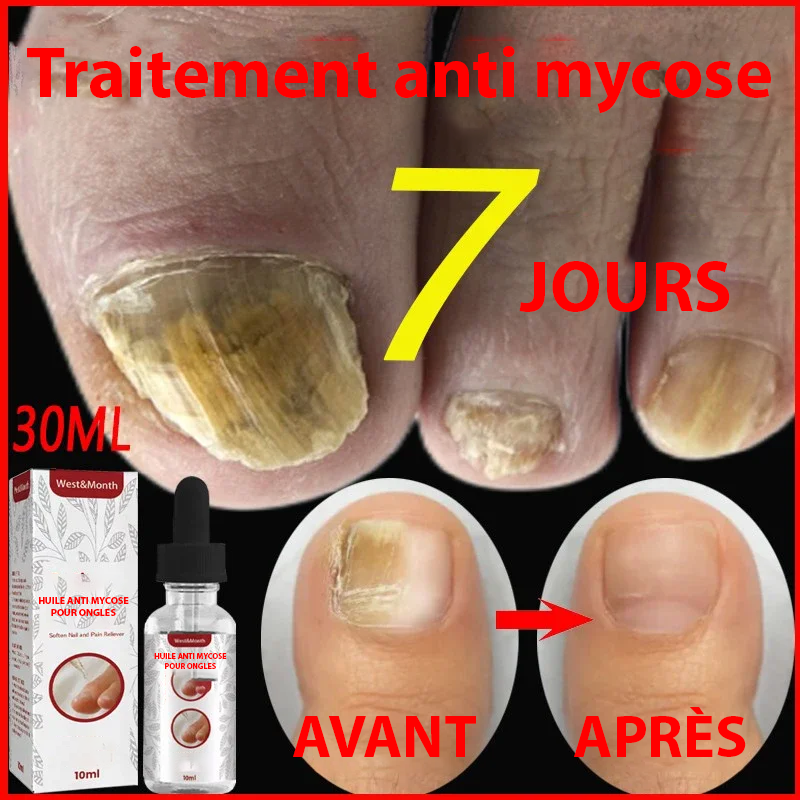 Traitement Antifongique Pour Mycose Des Ongles – Flacon 30 Ml, Soin Réparateur – Neuf